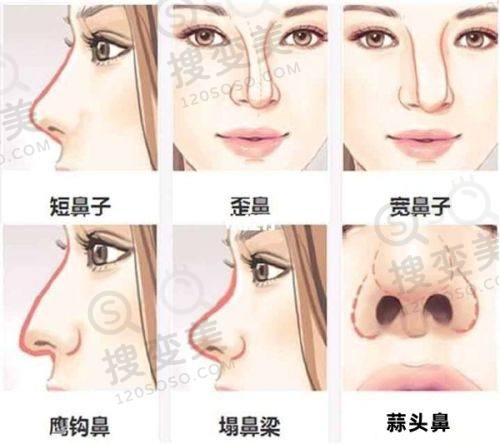 长春做双眼皮价格多少钱——长春原升医美