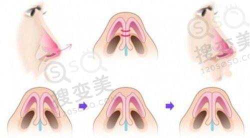 扬州艾菲斯韩国整形做双眼皮价格之多种术式
