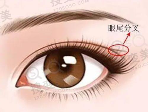 重庆松山医院双眼皮修复费用是多少？段艳军修复技术优收费合理——患者实例见证技术实力