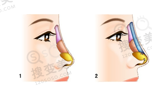 重庆松山医院双眼皮修复费用是多少?段艳军个性化修复,口碑好收费合理