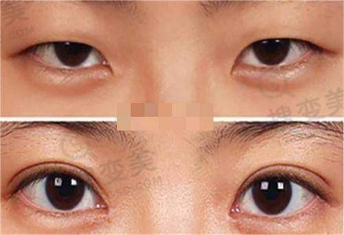 硅胶假耳朵要多少钱？5D仿真义耳价格揭秘