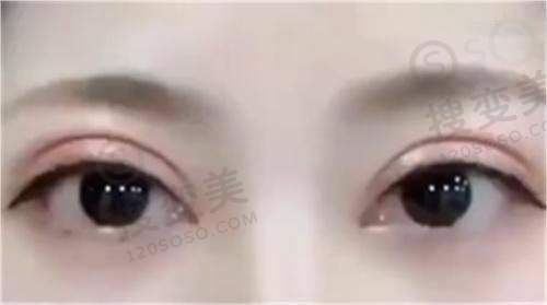成都艾米丽整形价格表更新,吸脂/鼻综合/双眼皮收费透明,医生口碑佳