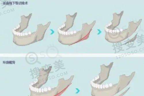 泉州海峡做双眼皮好的医生吴赞之双眼皮手术价格与方案