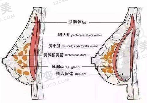 泉州做埋线双眼皮多少钱:低价陷阱与风险