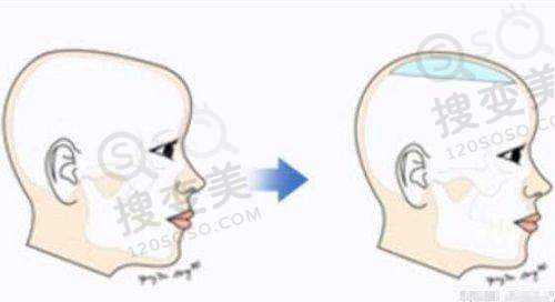 热玛吉五代全脸做一次多少钱——如何选择合适的医院和医生