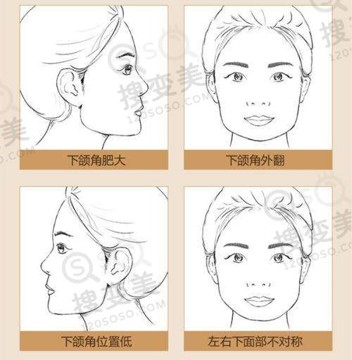 热玛吉五代全脸做一次多少钱——常见疑问解答