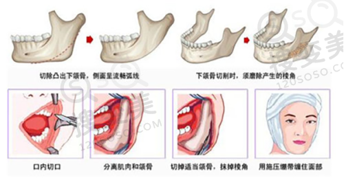 泉州华厦眼科医院林巧雅医生手术优势