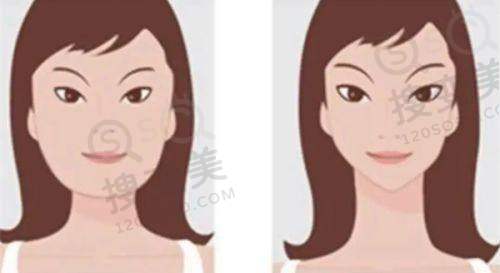 泉州做埋线双眼皮多少钱:不同医院的价格情况