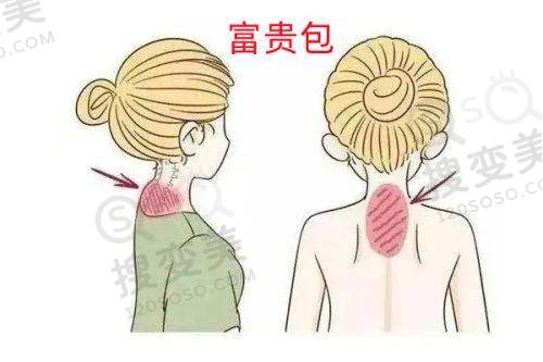 硅胶假耳朵要多少钱?影响价格的因素分析