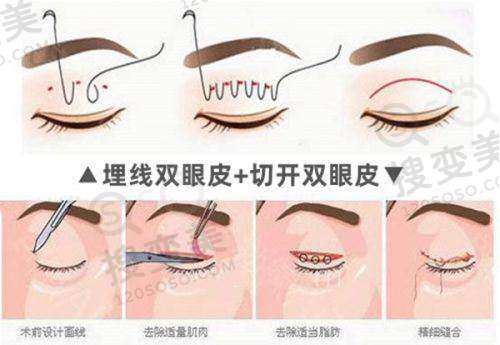 快看泉州哪家医院吸脂手术比较好——私立医美机构之海峡、西华、美莱