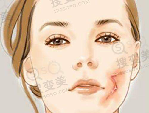 成都艾米丽整形价格表更新之鼻综合价格