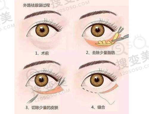 太原做眼综合手术的价格:如何选择合适的医生和医院