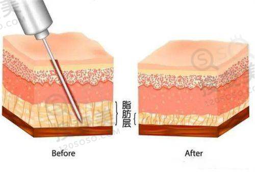 泉州面部吸脂好的医院汇总——综合实力较强的医院