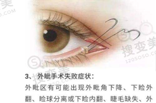 长沙凯莱刘凯做鼻子为什么那么贵之丰富经验的价值