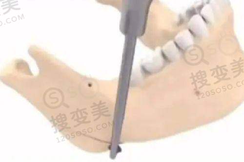 长沙整形美容医院在线预约，多院可选含华韩华美/爱思特张姣姣双眼皮