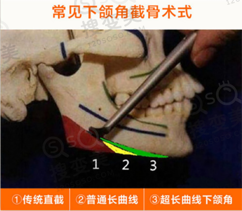 长沙凯莱刘凯做鼻子为什么那么贵之出色审美的体现
