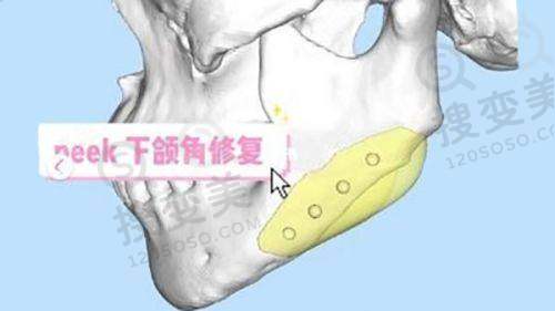 2025长沙美莱整形价格表之其他项目