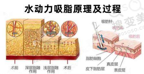 长沙雅美整形医院在哪？医院在长沙天心区，李成矫正乳房下垂技术优