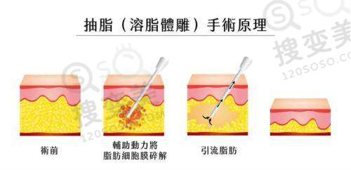 长沙做人鱼体雕医院有哪些——选择医院的要点