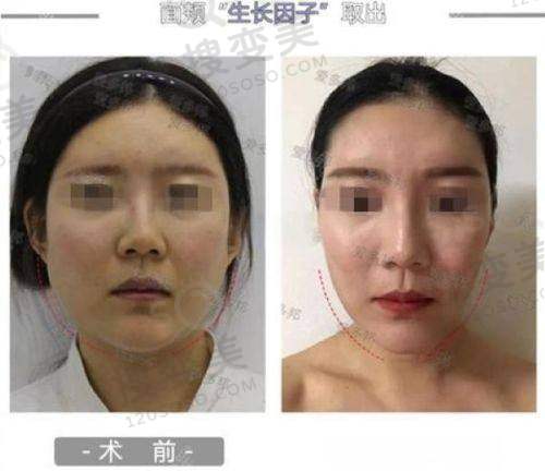 贵阳腹壁整形医院哪家好——利美康医院的手术价格