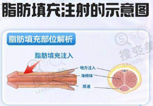 厦门欧菲有法芮娅假体隆胸价格,袁纯新医生技术优定制佳收费合理