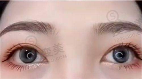 北京米兰柏羽丽都隆胸实例见证成效