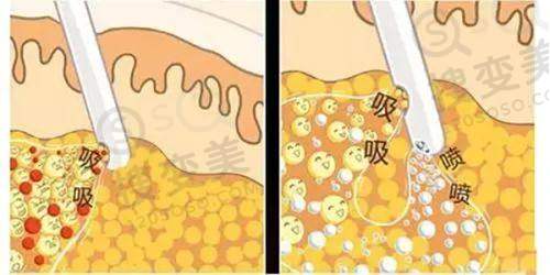 深圳阳光整形高端铂蕴假体隆胸价格与其他隆胸项目对比
