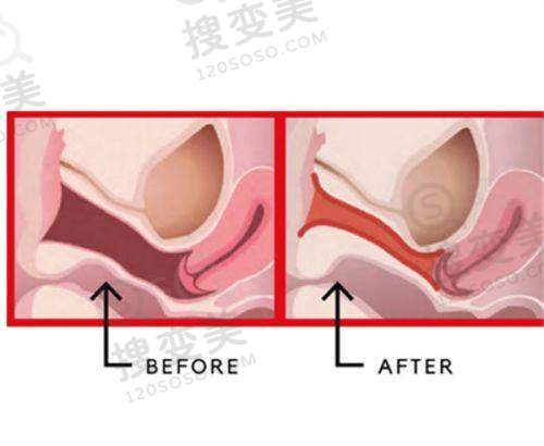 李高峰隆胸多少钱:不同手术方式的价格