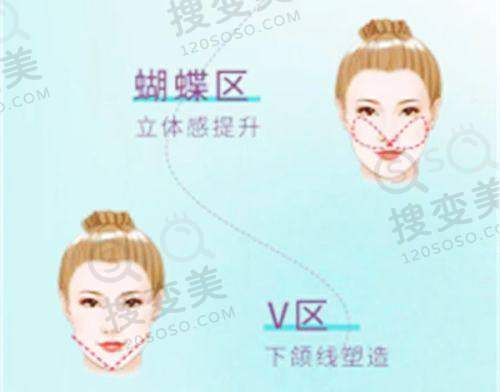 武汉艺星做曼托圆盘光面假体隆胸价格:不同假体系列价格