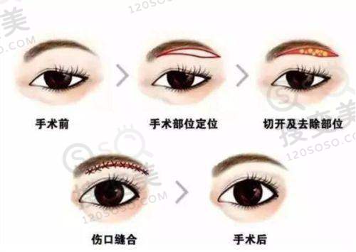 厦门欧菲有法芮娅假体隆胸价格之其他隆胸项目价格参考