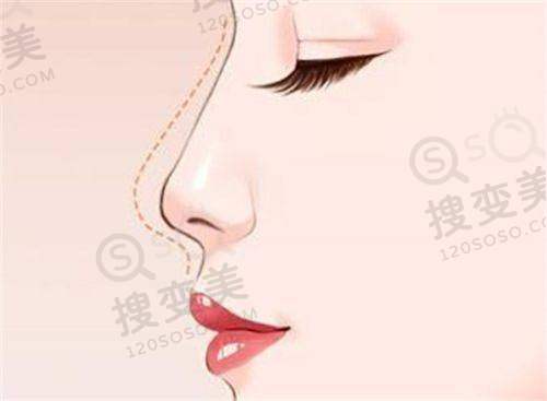上海艺星陈成傲诺拉假体隆胸价格之与其他医院对比