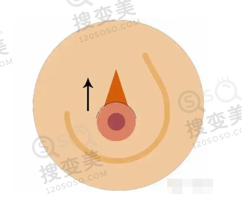 吕方中和甘海平谁修复双眼皮好？技术风格差异对比
