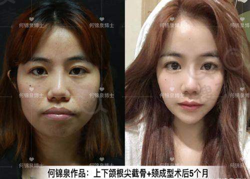 吕方中高难度眼修复真实范例曝光:核心技术精良