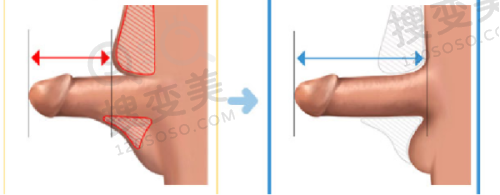 吕方中医生双眼皮失败修复病例是真多——部分典型病例展示