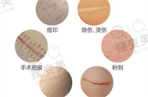取异物/馒化修复技术优——馒化修复技术亮点