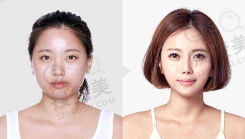 吕方中医生修复双眼皮口碑好之预约方式多样