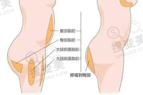 广州新市医院是正规3级医院，吕方中眼整形技术优收费合理口碑好 