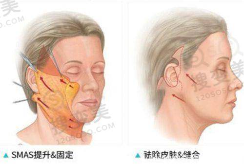 广州眼周筋膜提升医院排名前十2025之院长面诊必问问题