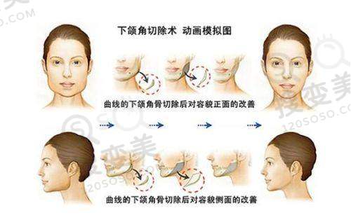 吕方中和甘海平谁修复双眼皮好？口碑评价对比
