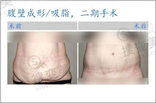 吕方中个人简历之双眼皮修复技术