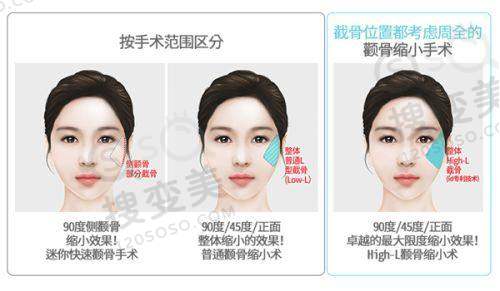 必看!2025广州十大无痕筋膜提升医院之广州美莱医疗美容医院