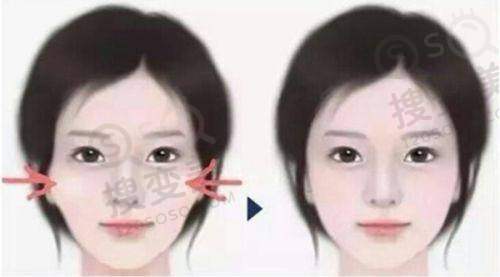 吕方中医生修复双眼皮口碑好之成功实例
