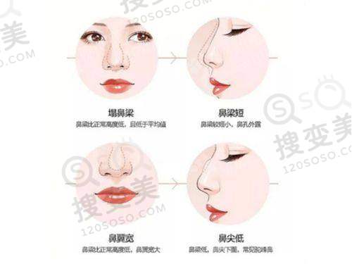 吕方中做双眼皮被投诉了几次?——技术实力说话