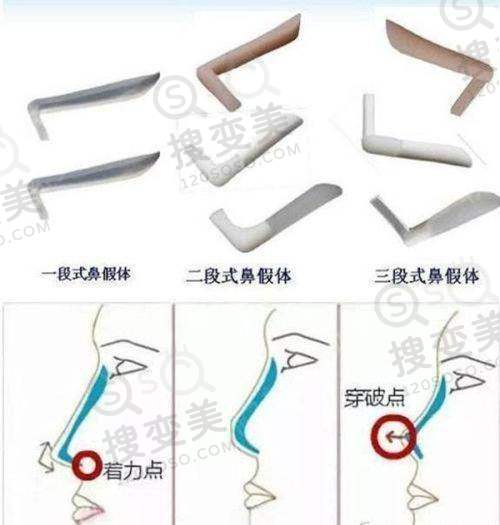 2025广州吕方中收费明细之其他眼部整形项目价格