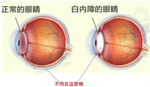 白内障免费治疗怎么申请？深圳/松原/广元多地政策及定点医院全揭秘