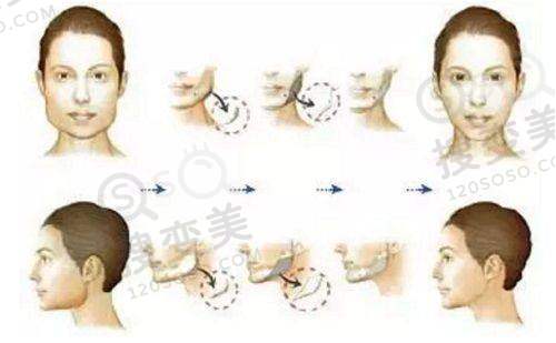 套筒冠义齿的美观舒适性