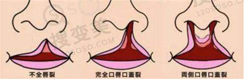 什么型的B更好?——整形医院推荐及成效揭秘