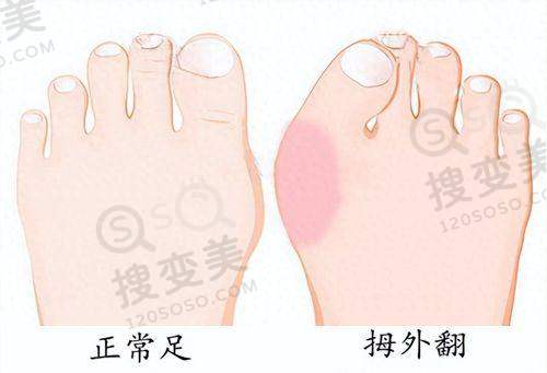 娜绮丽隆胸之成效呈现