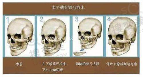 北京广济医院是私立吗？属公立一甲医院，拇外翻/疤痕治疗技术优口碑好 
