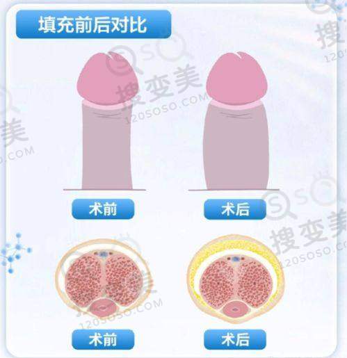 华美整形美容医院价目表之鼻部整形